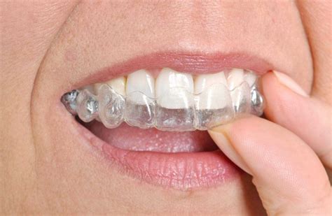 invisalign valbonne|Invisalign Philippines .